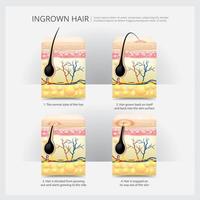 Ingrown Hair Structure Vector Illustration Set