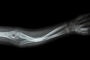film x ray forearm AP  show fracture shaft of ulnar  forearm s bone photo