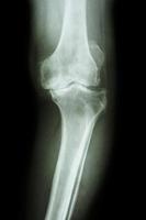 Película de rayos x rodilla ap de osteoartritis rodilla paciente oa rodilla foto