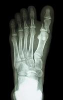 film x ray show fracture proximal phalange at first toe photo