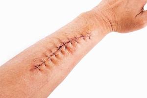 Surgery wound fix with staple on arm isolated on white background photo