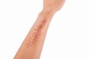 Surgical wound on the arm isolated on white background photo