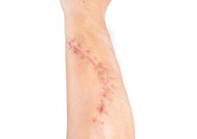 Surgical wound on the arm isolated on white background photo