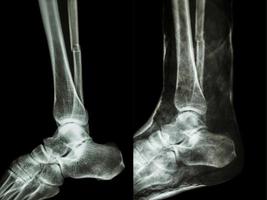 Left image   Fracture shaft of fibula calf bone    Right image  It was splinted with plaster cast