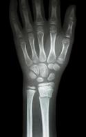 film x ray wrist show fracture distal radius  forearm s bone photo