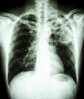 La radiografía de tórax de la película muestra un infiltrado alveolar en la parte superior del pulmón izquierdo debido a una infección por Mycobacterium tuberculosis tuberculosis pulmonar foto