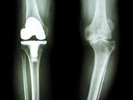 Radiografía de película de rodilla del paciente de rodilla con osteoartritis y articulación artificial foto