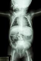 radiografía de película todo el cuerpo del bebé mostrar el cuerpo normal del bebé