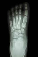 film xray foot front view  show normal child s foot photo