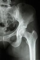 Película radiografía cadera izquierda mostrar articulación de la cadera humana normal foto
