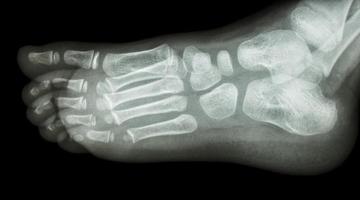 film xray foot oblique view show normal child s foot photo