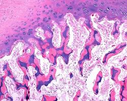 Epiphyseal ossification Mixed trabeculae photo