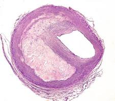 Artery atheroma plaque photo