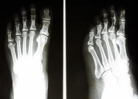 film Xray show normal bone of human s foot photo