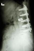 Película de rayos X muestran la columna lumbar con fijación de tornillos pediculares en pacientes con espondilolistesis foto