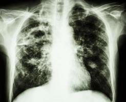 película radiografía de tórax muestra cavidad en el pulmón derecho fibrosis intersticial parcheado infiltrado en ambos pulmones debido a infección por Mycobacterium tuberculosis tuberculosis pulmonar foto