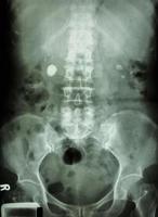 film Xray show bilateral renal stone  round shaped at right and left side