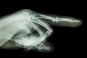 human is pointing the finger  film x ray photo