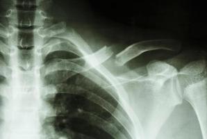 Film Xray show complete fracture middle left clavicle photo