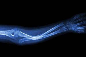 Film X ray fracture ulnar bone  forearm bone photo