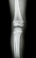 film x ray knee AP  antero posterior view of child photo