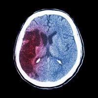El cerebro de TC muestra hipodensidad de accidente cerebrovascular isquémico en el lóbulo parietal frontal derecho foto