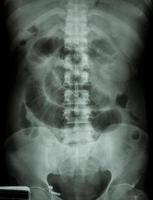 Small intestine obstruction  Film X ray abdomen supine  Show small intestine dilate due to small intestine obstruction photo