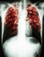 Pulmonary Tuberculosis  film chest x ray show interstitial infiltrate both lung due to Mycobacterium tuberculosis infection photo