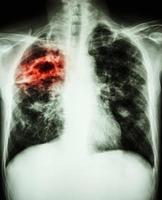 film chest xray show cavity fibrosis and interstitial infiltrate at right lung due to Mycobacterium tuberculosis infection  Pulmonary Tuberculosis photo