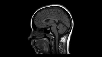 A close up black and white image of a lateral MRI scan of the human head video