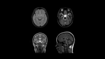 4 Nahaufnahmen in Schwarzweiß von allen vier Seiten des MRT-Scans des menschlichen Kopfes video