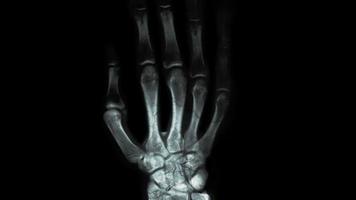 Human hand xray or hand bone disease research
