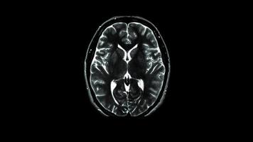 radiografía o tomografía computarizada de la parte superior de la cabeza humana video