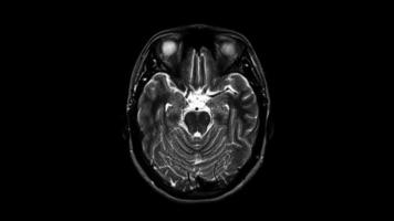 A close up black and white image of an MRI scan of the top of the human head video