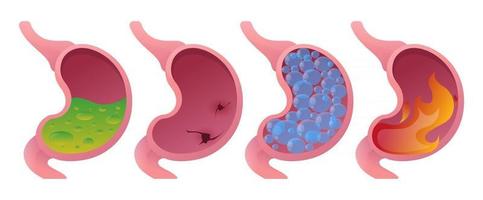 malestar estomacal gastritis hinchazón úlceras vector