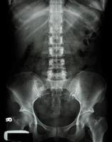 X-ray lumbo-sacral spine and pelvis of asian adult people photo