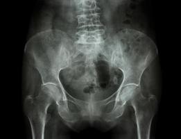 Pelvis de rayos X de película de paciente con osteoporosis foto