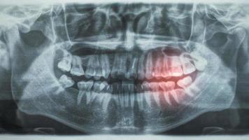 radiografía dental panorámica, con zona dolorosa roja foto