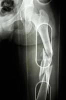 Film X-ray show comminute fracture shaft of femur photo