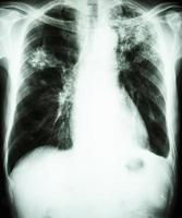 La radiografía de tórax de la película muestra un infiltrado alveolar en el pulmón superior izquierdo y el pulmón medio derecho debido a una infección por Mycobacterium tuberculosis tuberculosis pulmonar foto