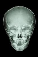 film x-ray skull AP view show normal thai child s skull photo