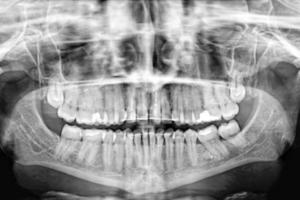 Exploración panorámica de rayos X de los dientes humanos. Examen y tratamiento. banner de cuidado dental.