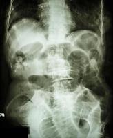 radiografía de la película del abdomen en decúbito supino que muestra el intestino delgado dilatado y aire en el intestino delgado debido a una obstrucción del intestino delgado foto