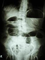 radiografía de la película del abdomen en posición vertical muestra el intestino delgado dilatado y el nivel hidroaéreo en el intestino delgado debido a una obstrucción del intestino delgado foto