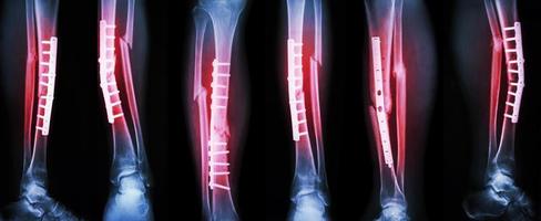 Collection image of leg fracture and surgical treatment by internal fixation with plate and screw . Break tibia and fibula bone . photo