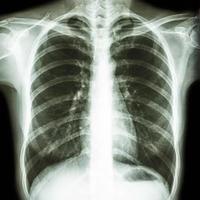 La radiografía de tórax de película muestra el tórax humano normal foto