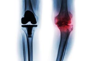 Film x-ray of osteoarthritis knee patient and artificial joint  Total knee replacement  . Isolated background . photo