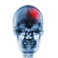 Stroke  Cerebrovascular accident  . Film x-ray skull of human with red area . Front view photo