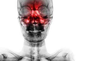 sinusitis en el seno frontal, etmoidal y maxilar. Radiografía de película de cráneo y área en blanco en el lado derecho foto