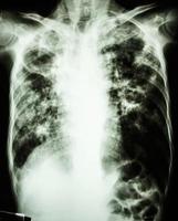Film chest x-ray show cavity at right lung,fibrosis and interstitial and patchy infiltrate at both lung due to Mycobacterium tuberculosis infection  Pulmonary Tuberculosis